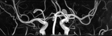  MRA画像（脳血管画像）